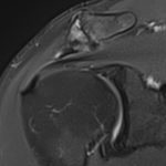 arthrose acromio-claviculaire IRM 1