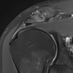 arthrose acromio-claviculaire IRM 2