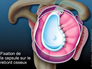 suture labrale suture labrale