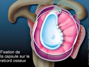 suture labrale