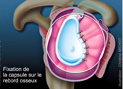 suture labrale