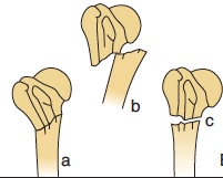 Fracture extra-articulaire du col chirurgical du col chirurgical