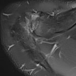 arthrose acromio-claviculaire IRM 3