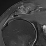 arthtose acromio-claviculaire TDM 3